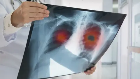Getty Images A doctor holds an x-ray of a patient's lungs