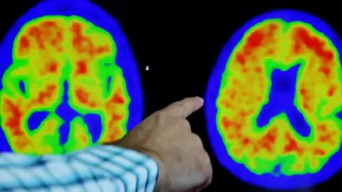 Reuters A doctor points out evidence of Alzheimer's disease on PET scans
