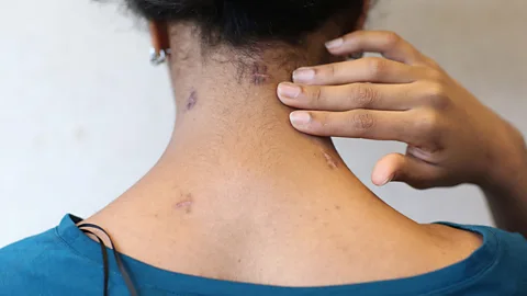 Getty Images Knife attack survivor Samar Haroun shows the scars that remain on the back of her neck in 2013 (Credit: Getty Images)