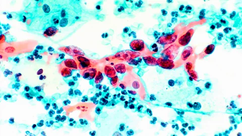 Alamy In Romania, there is a general lack of trust in the healthcare system, which might explain the abundance of conspiracy theories about the HPV vaccine (Credit: Alamy)