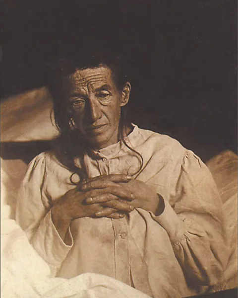 Wikipedia In the early 1900s, Auguste Deter was the first person to be diagnosed with Alzheimer's (Credit: Wikipedia)