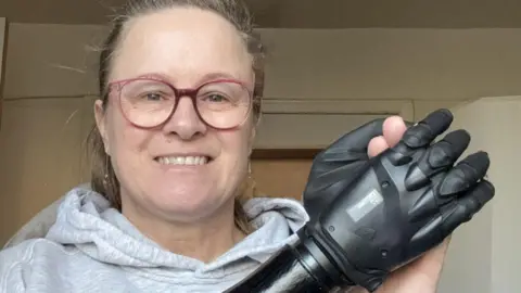 Wirral University Teaching Hospital Julie Griffin has long brown hair tied back in a ponytail. She is wearing glasses, a grey hoodie, is smiling, and holding her black prosthetic arm across her chest.
